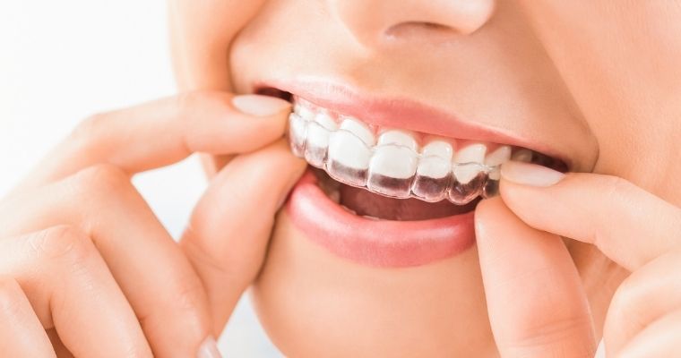 Invisalign-faqs